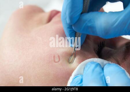 la donna usa il bastone di rimozione dell'acne per rimuovere i pimples di whitehead sulla faccia schiacciando sui pimples che si schiumano, faccia oleosa Foto Stock