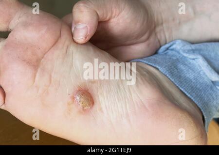 Eczema disidrotico sul piede. L'uomo mostra dermatite vescicolosa. Viene trattato con unguento. Primo piano. Foto Stock