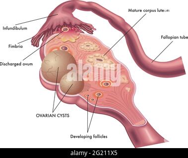 Illustrazione medica di una cisti ovarica e della sua posizione. Illustrazione Vettoriale