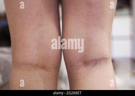 La fase iniziale delle vene varicose, dolore alle gambe. Foto di alta qualità Foto Stock