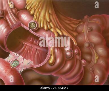 Dettaglio del colon che mostra la diverticolosi. Foto Stock