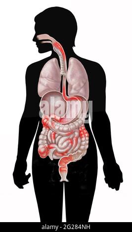 Posizioni comuni della malattia di Crohn nel sistema gastrointestinale sulla figura di silhouette. Foto Stock