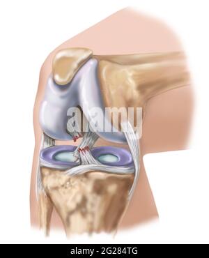 Ginocchio piegato che mostra un legamento crociato anteriore strappato. Foto Stock