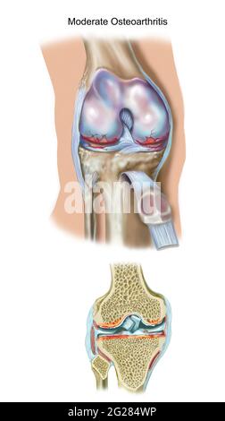 Vista frontale e sezione trasversale del ginocchio con osteoartrite moderata. Foto Stock