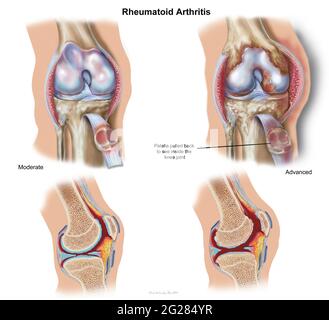 Vista frontale e sezione trasversale del ginocchio che mostra artrite reumatoide moderata e avanzata. Foto Stock