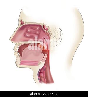 Vista laterale della testa che mostra la posizione delle tonsille gonfie e ingrandite. Foto Stock