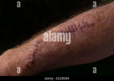 Ferite chirurgiche con suture e punti dopo un'operazione sul braccio di un maschio anziano per rimuovere carcinomi a cellule squamose o tumori della pelle che sono t Foto Stock