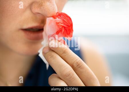 Donna cerca di fermare il sangue che fuoriesce dal naso Foto Stock