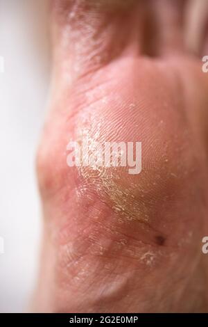 La malattia sulla gamba dell'uomo. Primo piano del piede asciutto. Foto Stock