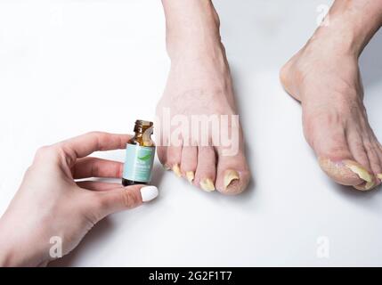 Aprile 2021, Swansea, Regno Unito. La donna sta applicando l'olio dell'albero del tè, il trattamento del fungo del chiodo alle unghie lunghe infettate dell'uomo Foto Stock