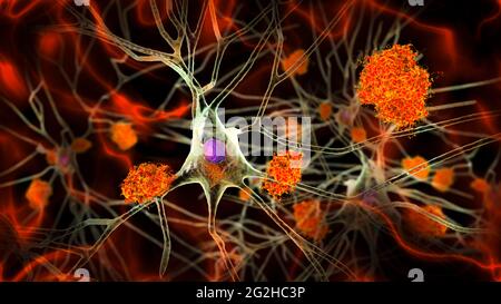 Cellule nervose colpite dal morbo di Alzheimer, illustrazione Foto Stock