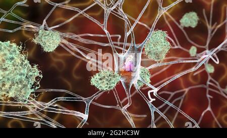 Cellule nervose colpite dal morbo di Alzheimer, illustrazione Foto Stock