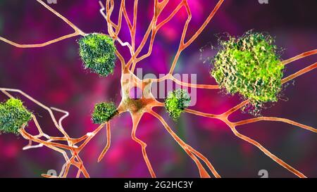 Cellule nervose colpite dal morbo di Alzheimer, illustrazione Foto Stock