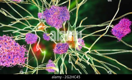 Cellule nervose colpite dal morbo di Alzheimer, illustrazione Foto Stock