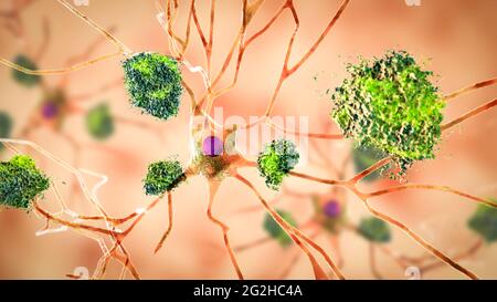 Cellule nervose colpite dal morbo di Alzheimer, illustrazione Foto Stock