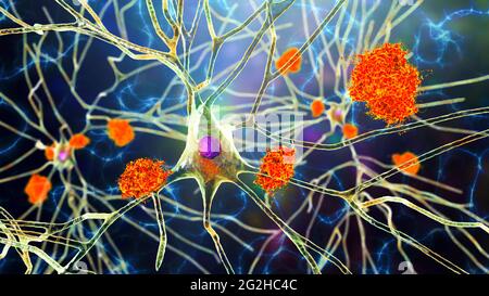 Cellule nervose colpite dal morbo di Alzheimer, illustrazione Foto Stock