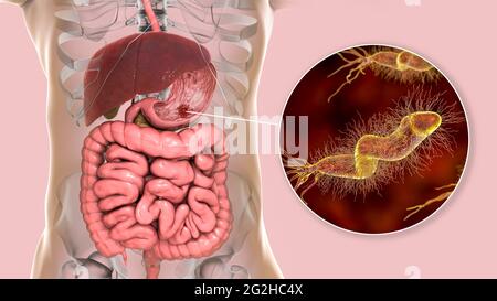 Ulcera gastrica e batteri Helicobacter pylori, illustrazione Foto Stock