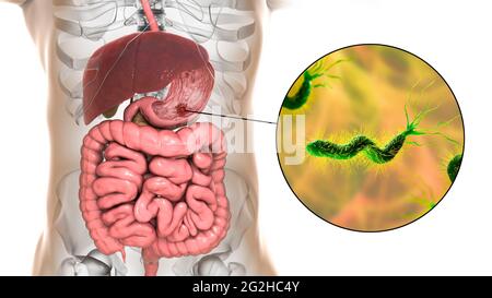 Ulcera gastrica e batteri Helicobacter pylori, illustrazione Foto Stock