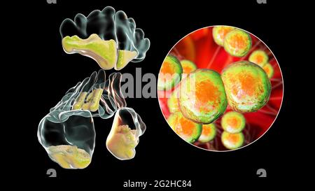 Sinusite, illustrazione Foto Stock