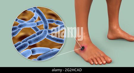 Antrace cutaneo, illustrazione Foto Stock