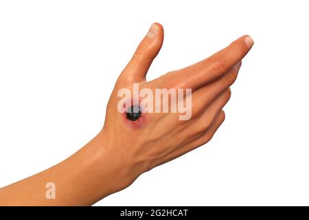 Antrace cutaneo, illustrazione Foto Stock