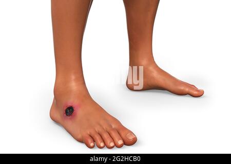 Antrace cutaneo, illustrazione Foto Stock