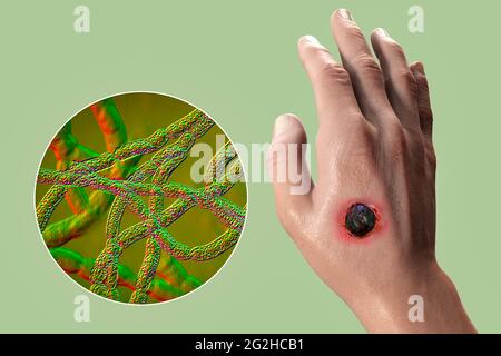 Antrace cutaneo, illustrazione Foto Stock