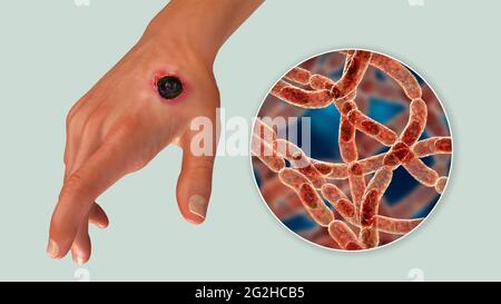 Antrace cutaneo, illustrazione Foto Stock