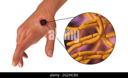 Antrace cutaneo, illustrazione Foto Stock