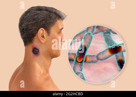 Antrace cutaneo, illustrazione Foto Stock