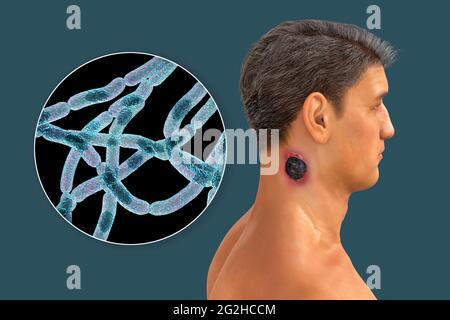 Antrace cutaneo, illustrazione Foto Stock
