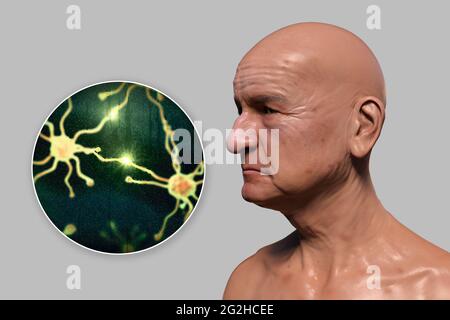 Demenza, illustrazione concettuale Foto Stock