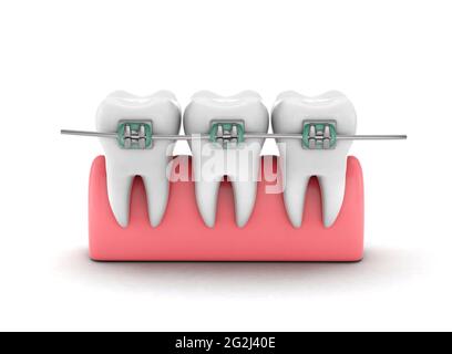 Dentature. Allineamento dei denti. I denti della gomma sono isolati su sfondo bianco. rendering 3d. Foto Stock