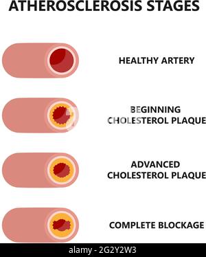 Stadi di aterosclerosi. Formazione e crescita di placche di colesterolo. Illustrazione Vettoriale