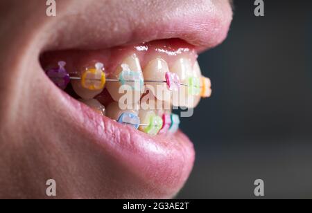 Immagine in primo piano orizzontale del sorriso della bella donna, che mostra denti bianchi sani con bretelle in ceramica, uniti con un filo e colorate fasce in gomma. Vista laterale. Concetto di ortodonzia Foto Stock