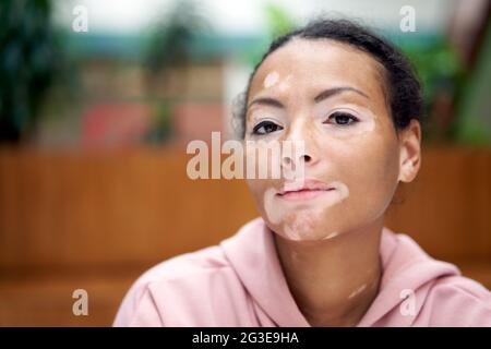 Donna nera afroamericana con pigmentazione vitiligina problema della pelle interna felpa con cappuccio rosa vestita primo piano ritratto pensivo nero pensiero femminile informazioni su Foto Stock