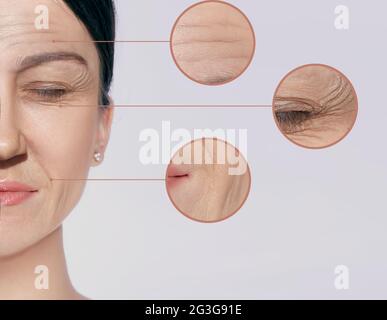 Rughe, invecchiamento della fronte, pieghe nasolabiali e intorno agli occhi. Alterazioni cutanee correlate all'età Foto Stock