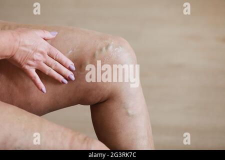 La donna sfrega le gambe stanche con una crema speciale per ridurre il dolore. Flebologia. Vene dolorose di varicose e ragno sulle gambe femminili attive, la medicina e l'healt Foto Stock