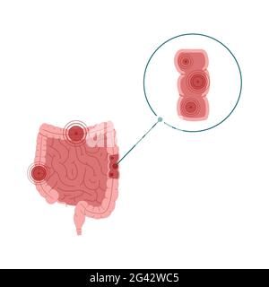 Illustrazione del vettore della malattia infiammatoria intestinale isolata su sfondo bianco Foto Stock