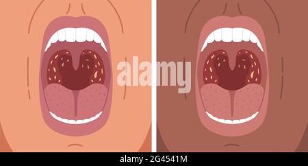 Illustrazione vettoriale di tonsillite batterica, mal di gola, pietre tonsili. Foto Stock