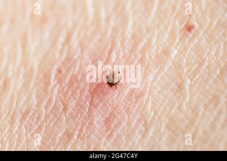 Inginzito, nutrendo zecca di cervo femminile adulta, Ixodes scapularis, deponendo uova rosse, sporgendo sotto il suo corpo, succhiando sangue dalla pelle di femmina umana. Foto Stock