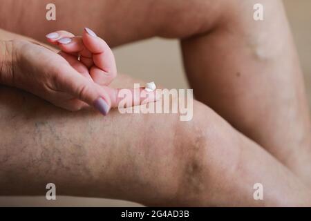 La donna sfrega le gambe stanche con una crema speciale per ridurre il dolore. Flebologia. Vene dolorose di varicose e ragno sulle gambe femminili attive, la medicina e l'healt Foto Stock