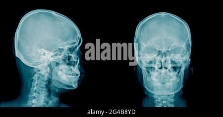 Immagine radiografica del cranio umano AP e vista laterale in blu Foto Stock