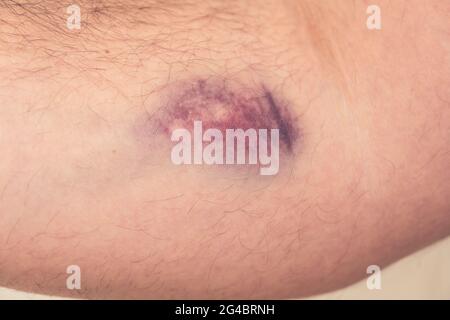 Lividi dalla raccolta del sangue su sfondo bianco. Immagine ravvicinata Foto Stock