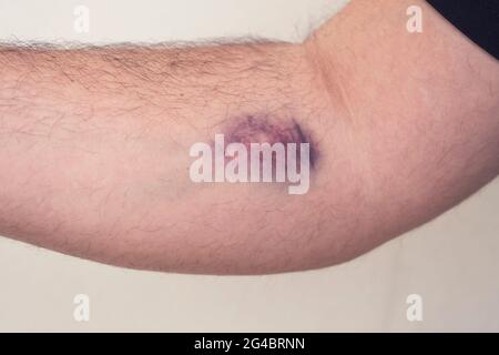 Lividi dalla raccolta del sangue su sfondo bianco. Immagine ravvicinata Foto Stock