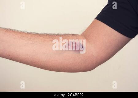 Lividi dalla raccolta del sangue su sfondo bianco. Immagine ravvicinata Foto Stock