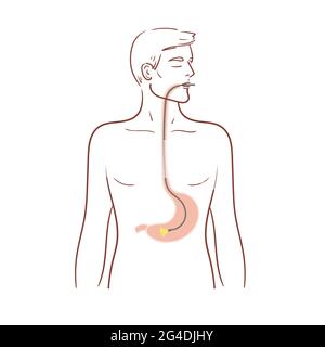 Gastroscopia dello stomaco. Esofagoscopia,procedura diagnostica.Un uomo è sottoposto ad un esame medico. Ststock illustrazione isolata su bianco Illustrazione Vettoriale