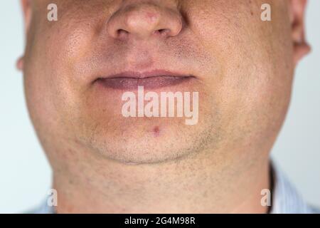 Faccia maschio con i pimples sul naso e mento vicino. Foto Stock