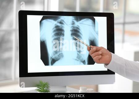 Pulmonologa che indica l'immagine radiografica dei polmoni in clinica Foto Stock