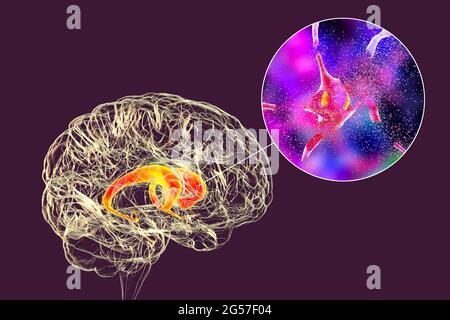 Distruzione di neuroni del nucleo caudato, illustrazione Foto Stock